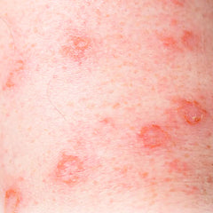 Collection image for: Eczema