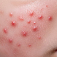 Collection image for: Acne