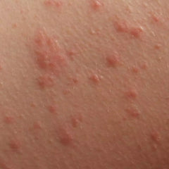 Collection image for: Body Rash