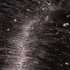 Dry & Itchy Scalp - Simply Kids