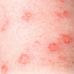 Eczema - Simply Kids