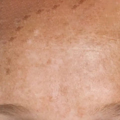 Hyperpigmentation - Simply Kids