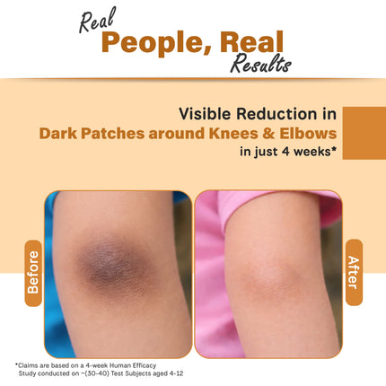 Before and after comparison of dark patches around knees and elbows with text 'Real People, Real Results' and 'Visible Reduction in Dark Patches around Knees & Elbows in just 4 weeks'.
