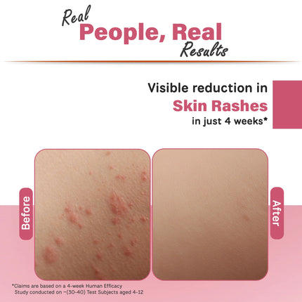 Before and after comparison showing visible reduction in skin rashes after 4 weeks using Simply Kids body wash