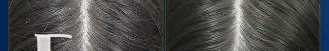 Before and after view of a child’s scalp showing reduced dandruff and healthier hair after using a kids anti-dandruff shampoo that softens hair and strengthens roots